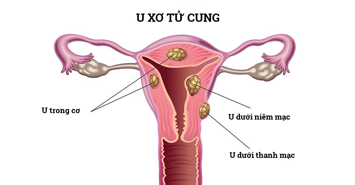 BỆNH U XƠ TỬ CUNG