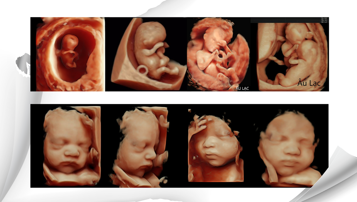 SIÊU ÂM SÀNG LỌC DỊ TẬT THAI