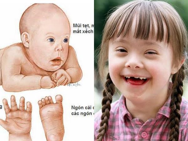 Sàng lọc trước sinh