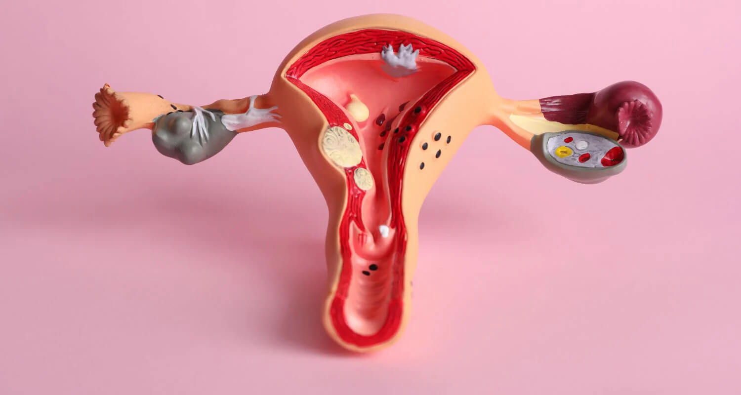 BỆNH VIÊM ÂM HỘ – ÂM ĐẠO